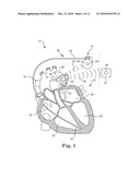 PHYSIOLOGIC SIGNAL MONITORING USING ULTRASOUND SIGNALS FROM IMPLANTED DEVICES diagram and image