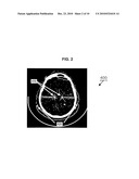 METHOD OF DETERMINING THE POSITION OF A DEEP BRAIN STIMULATION ELECTRODE diagram and image