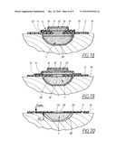  DEVICE FOR TREATMENT OF WOUNDS WITH REDUCED PRESSURE diagram and image