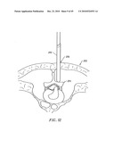 SYSTEMS AND METHODS FOR ELECTROSURGICAL INTERVERTEBRAL DISC REPLACEMENT diagram and image