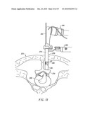 SYSTEMS AND METHODS FOR ELECTROSURGICAL INTERVERTEBRAL DISC REPLACEMENT diagram and image