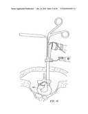 SYSTEMS AND METHODS FOR ELECTROSURGICAL INTERVERTEBRAL DISC REPLACEMENT diagram and image