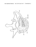 SYSTEMS AND METHODS FOR ELECTROSURGICAL INTERVERTEBRAL DISC REPLACEMENT diagram and image