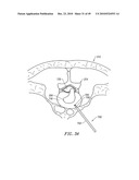 SYSTEMS AND METHODS FOR ELECTROSURGICAL INTERVERTEBRAL DISC REPLACEMENT diagram and image