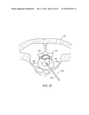 SYSTEMS AND METHODS FOR ELECTROSURGICAL INTERVERTEBRAL DISC REPLACEMENT diagram and image