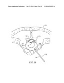 SYSTEMS AND METHODS FOR ELECTROSURGICAL INTERVERTEBRAL DISC REPLACEMENT diagram and image