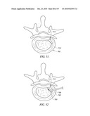 SYSTEMS AND METHODS FOR ELECTROSURGICAL INTERVERTEBRAL DISC REPLACEMENT diagram and image