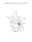 SYSTEMS AND METHODS FOR ELECTROSURGICAL INTERVERTEBRAL DISC REPLACEMENT diagram and image