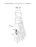 Fixation system, an intramedullary fixation assembly and method of use diagram and image