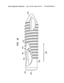 Fixation system, an intramedullary fixation assembly and method of use diagram and image