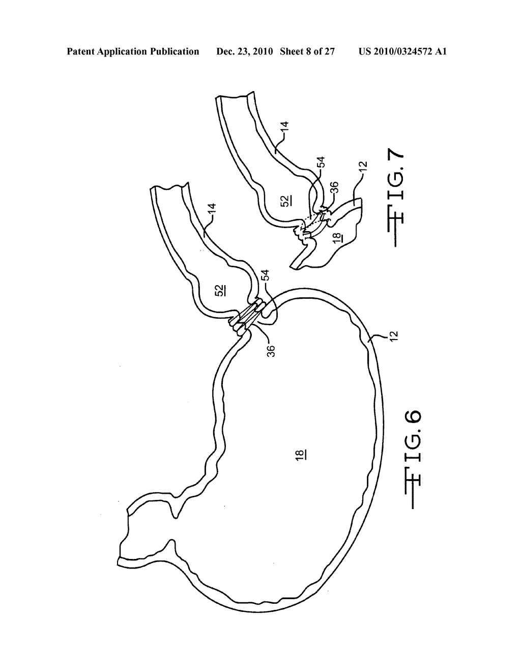 Endolumenal Restriction Method and Apparatus - diagram, schematic, and image 09