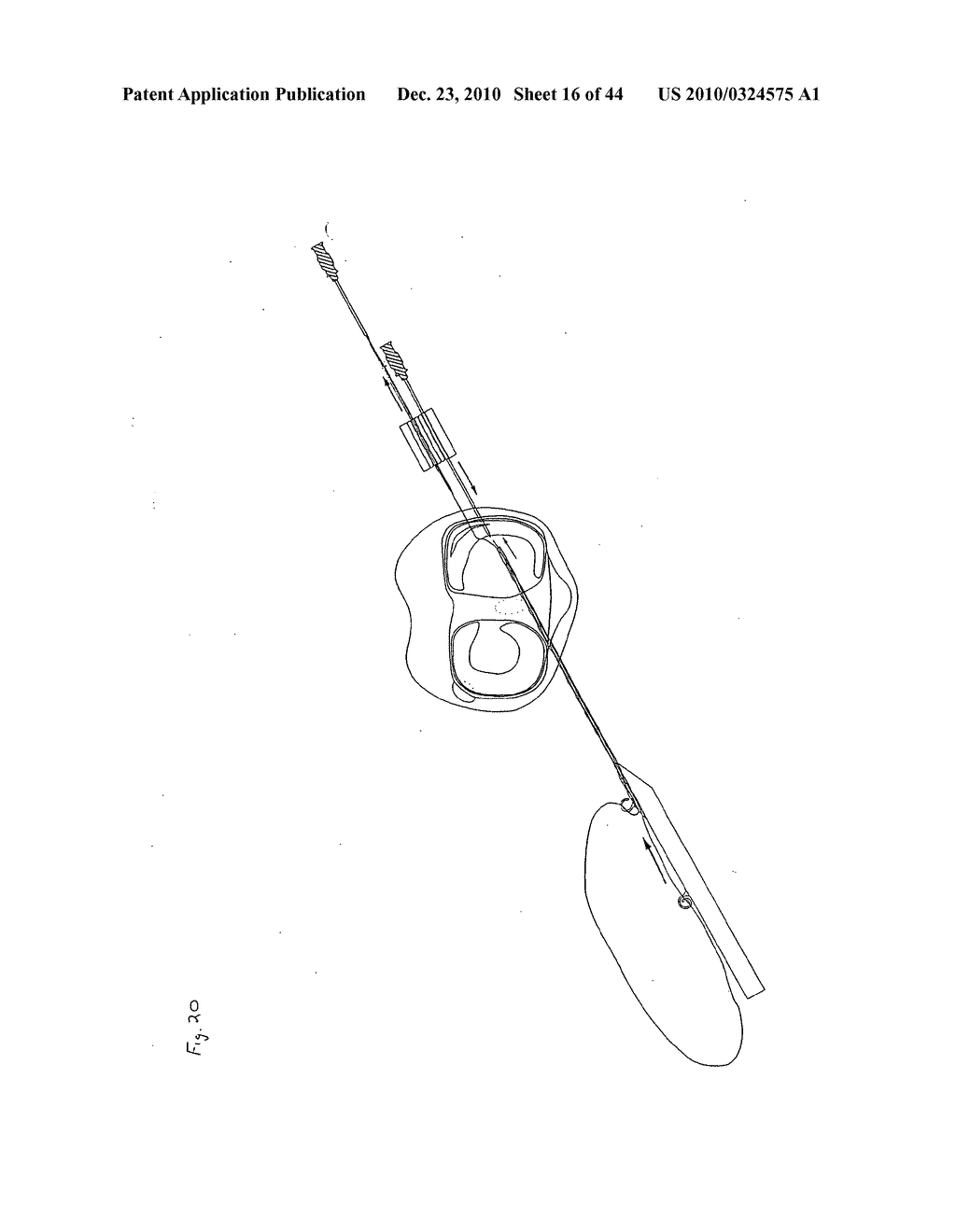 SURGICAL REPAIR KIT AND ITS METHOD OF USE - diagram, schematic, and image 17
