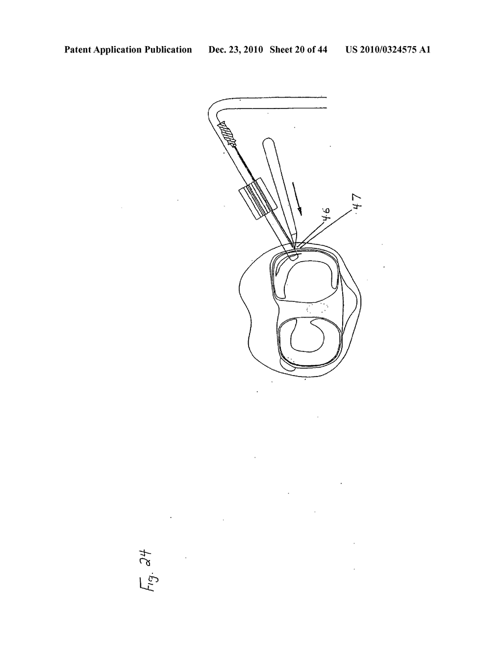 SURGICAL REPAIR KIT AND ITS METHOD OF USE - diagram, schematic, and image 21