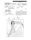 GRAFT PROTECTION MESH AND FIXATION TECHNIQUE diagram and image