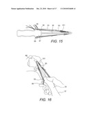 GRAFT PROTECTION MESH AND FIXATION TECHNIQUE diagram and image