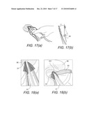 GRAFT PROTECTION MESH AND FIXATION TECHNIQUE diagram and image