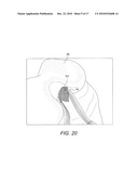 GRAFT PROTECTION MESH AND FIXATION TECHNIQUE diagram and image