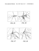 GRAFT PROTECTION MESH AND FIXATION TECHNIQUE diagram and image