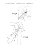 GRAFT PROTECTION MESH AND FIXATION TECHNIQUE diagram and image