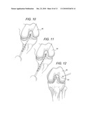 BONE-TENDON-BONE SUTURE BUTTON CONSTRUCTS AND METHODS OF TISSUE FIXATION diagram and image