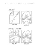 BONE-TENDON-BONE SUTURE BUTTON CONSTRUCTS AND METHODS OF TISSUE FIXATION diagram and image