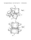 Intervertebral Implant Component With Three Points of Contact diagram and image