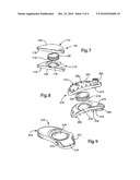 Intervertebral Implant Component With Three Points of Contact diagram and image