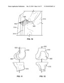 Method and Apparatus for Manufacturing an Implant diagram and image