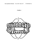 Oral appliance for altitude sickness diagram and image