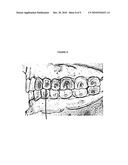 Oral appliance for altitude sickness diagram and image