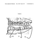 Oral appliance for altitude sickness diagram and image