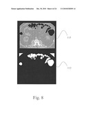 Method and System for Producing Interactive, Three-Dimensional Renderings of Selected Body Organs Having Hollow Lumens to Enable Simulated Movement Through the Lumen diagram and image