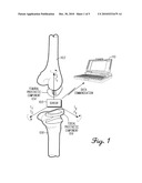 PULSED ECHO SENSING DEVICE AND METHOD FOR AN ORTHOPEDIC JOINT diagram and image