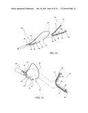 TISSUE COMPRESSION USING SURGICAL CLIPS diagram and image