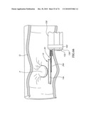 TISSUE COMPRESSION USING SURGICAL CLIPS diagram and image