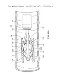 TISSUE COMPRESSION USING SURGICAL CLIPS diagram and image