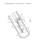 TISSUE COMPRESSION USING SURGICAL CLIPS diagram and image