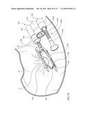 TISSUE COMPRESSION USING SURGICAL CLIPS diagram and image