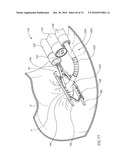 TISSUE COMPRESSION USING SURGICAL CLIPS diagram and image