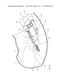 TISSUE COMPRESSION USING SURGICAL CLIPS diagram and image
