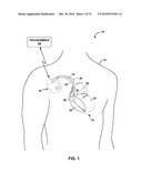 HEART SOUND SENSING TO REDUCE INAPPROPRIATE TACHYARRHYTHMIA THERAPY diagram and image