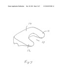 Method of Reducing Loading Failure for a Prosthetic Component diagram and image