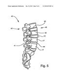 Bone fusion device and methods diagram and image