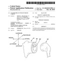 GLENOID IMPLANT WITH SYNTHETIC LABRUM diagram and image