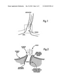 METHOD OF INSTALLING A TRANSCUTANEOUS PROSTHESIS diagram and image