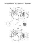 DEVICE FOR TREATING OBESITY diagram and image