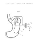 DEVICE FOR TREATING OBESITY diagram and image