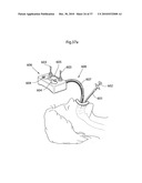 DEVICE FOR TREATING OBESITY diagram and image