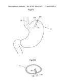 DEVICE FOR TREATING OBESITY diagram and image