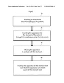 DEVICE FOR TREATING OBESITY diagram and image